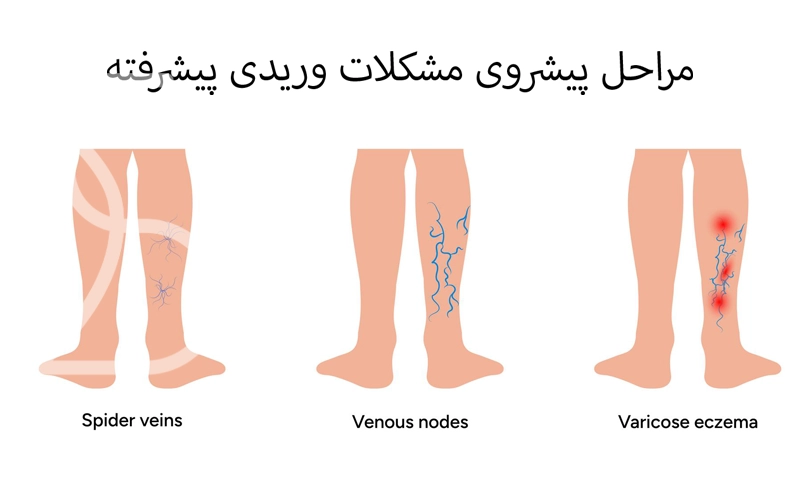 مراحل پیشروی مشکلات وریدی پا