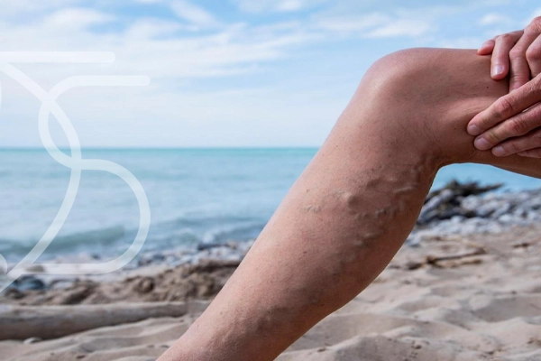 پوشیدن جوراب واریس برای بیماری