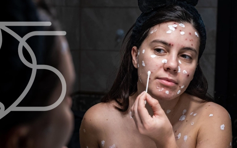 از بین بردن جای جوش