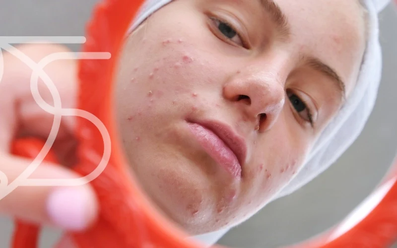 رفع دائمی جوش های صورت