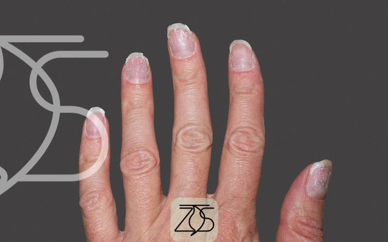 خطرات سرطان با کاشت ناخن