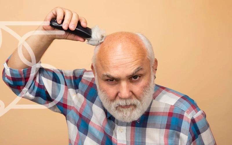 ریزش مو مردانه