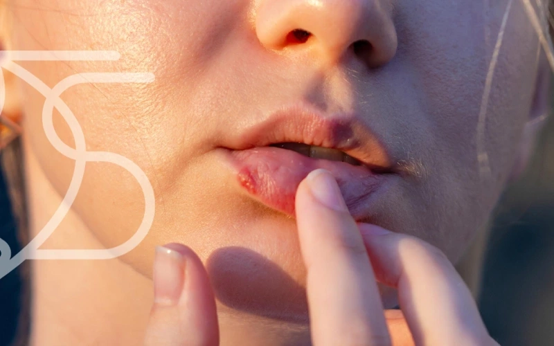 درمان تبخال لب