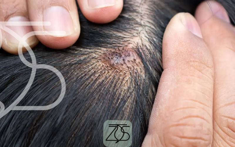 بهترین شامپو مو برای جوش سر