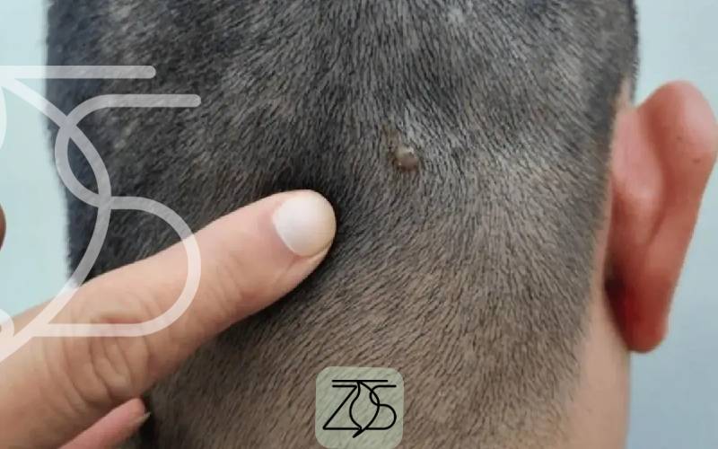 بهترین شامپو برای درمان جوش سر