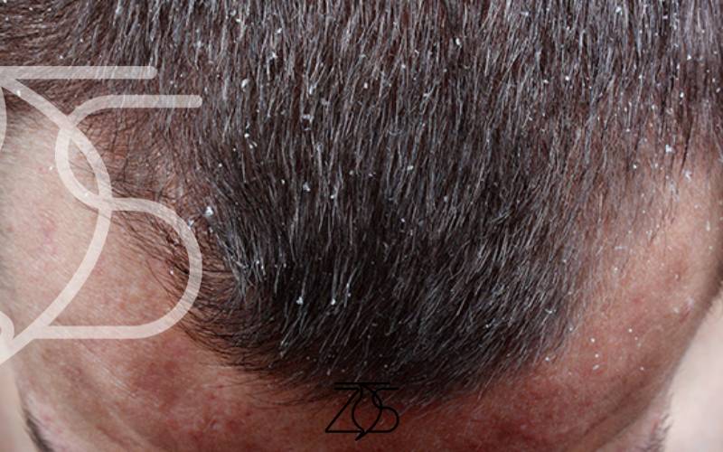 بهترین شامپو برای شوره سر