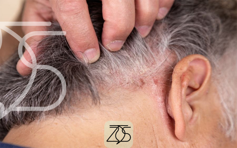 بهترین شامپو برای پسوریازیس پوست سر