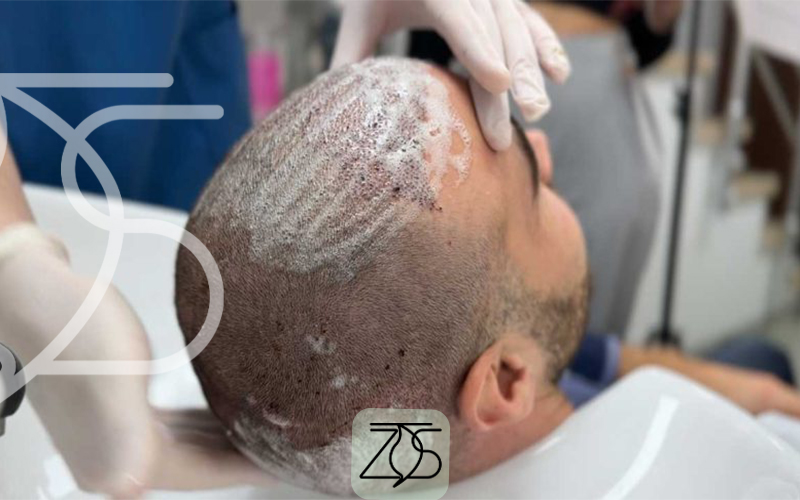 بهترین شامپو بعد از کاشت مو